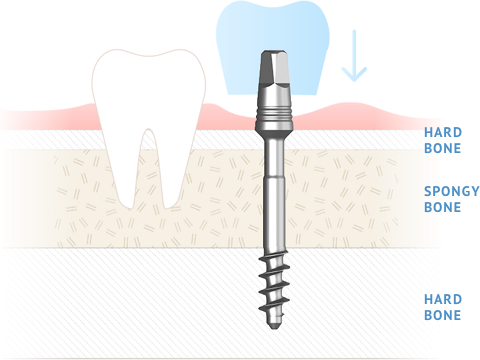 IHDE Implant
